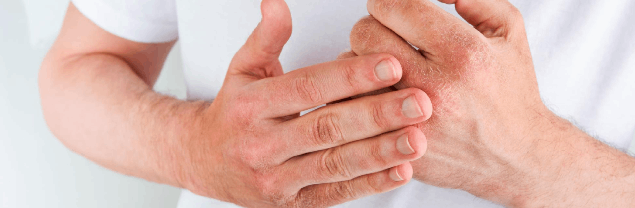 How to solve dry skin on your hands using CBD products