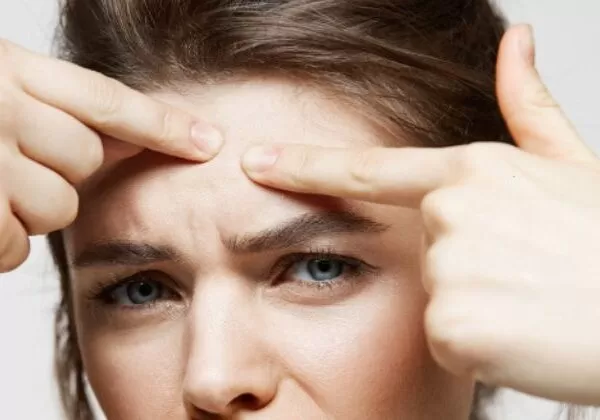 Blackheads: Causes, Prevention, and Effective Treatment