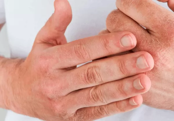 How to solve dry skin on your hands using CBD products